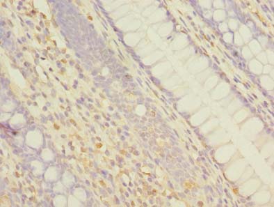 Immunohistochemistry of paraffin-embedded human colon cancer using ABCF3 Polyclonal Antibody at dilution of 1:100