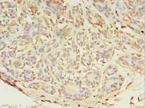 Immunohistochemistry of paraffin-embedded human breast cancer using ABHD14A Polyclonal Antibody at dilution 1:100