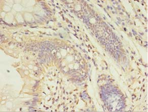 Immunohistochemistry of paraffin-embedded human colon cancer using ABHD14A Polyclonal Antibody at dilution 1:100