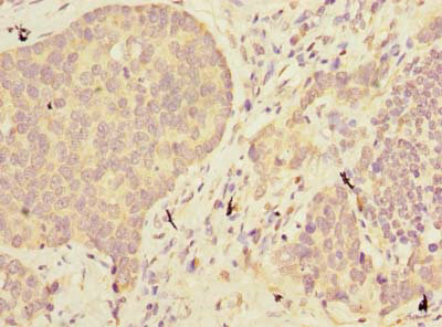 Immunohistochemistry of paraffin-embedded human gastric cancer at dilution of 1:100