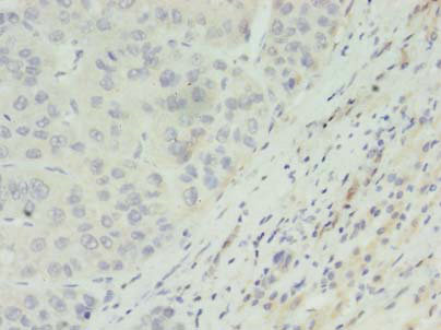 Immunohistochemistry of paraffin-embedded human liver cancer at dilution of 1:100
