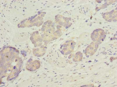 Immunohistochemistry of paraffin-embedded human gastric cancer using ACSBG2 Polyclonal Antibody at dilution of 1:100