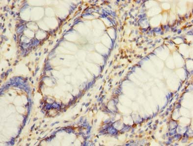 Immunohistochemistry of paraffin-embedded human colon cancer using ASB8 Polyclonal Antibody at dilution of 1:100