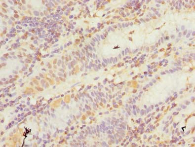 Immunohistochemistry of paraffin-embedded human gastric cancer using GHITM Polyclonal Antibody at dilution of 1:100
