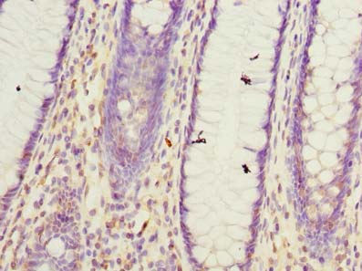 Immunohistochemistry of paraffin-embedded human colon cancer using GHITM Polyclonal Antibody at dilution of 1:100