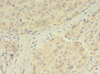 Immunohistochemistry of paraffin-embedded human liver cancer at dilution 1:100