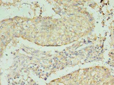 Immunohistochemistry of paraffin-embedded human lung cancer using NRG2 Polyclonal Antibody at dilution of 1:100
