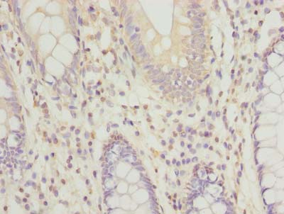 Immunohistochemistry of paraffin-embedded human colon cancer using RPRD1B Polyclonal Antibody at dilution of 1:100