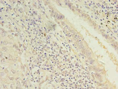 Immunohistochemistry of paraffin-embedded human lung cancer at dilution of 1:100