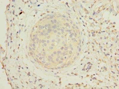 Immunohistochemistry of paraffin-embedded human cervical cancer using ZHX1-C8orf76 Polyclonal Antibody at dilution of 1:100