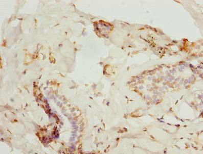 Immunohistochemistry of paraffin-embedded human breast cancer at dilution of 1:100