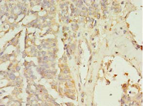 Immunohistochemistry of paraffin-embedded human endometrial cancer tissue at dilution 1:100