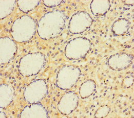 Immunohistochemistry of paraffin-embedded human gastric cancer at dilution of 1:100