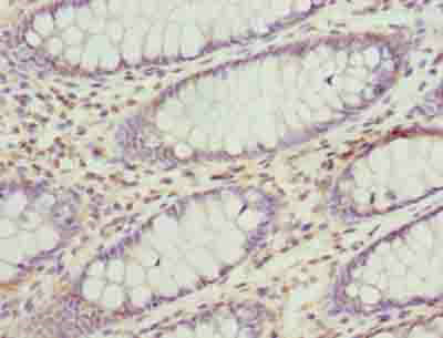 Immunohistochemistry of paraffin-embedded human colon cancer at dilution of 1:100