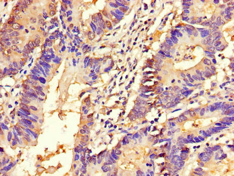 Immunohistochemistry of paraffin-embedded human colon cancer tissue at dilution of 1:100