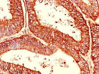 Immunohistochemistry of paraffin-embedded human endometrial cancer at dilution of 1:100