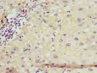 Immunohistochemistry of paraffin-embedded human liver cancer using FFAR3 Polyclonal Antibody at dilution of 1:100