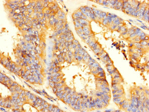 Immunohistochemistry of paraffin-embedded human endometrial cancer at dilution of 1:100