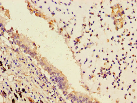 Immunohistochemistry of paraffin-embedded human lung cancer tissue at dilution of 1:100