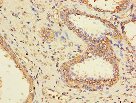 Immunohistochemistry of paraffin-embedded human prostate cancer tissue at dilution of 1:100