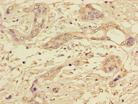 Immunohistochemistry of paraffin-embedded human pancreatic cancer tissue at dilution of 1:100