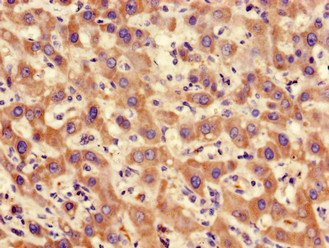 Immunohistochemistry of paraffin-embedded human liver cancer using PPP2CA Polyclonal Antibody at dilution of 1:100.