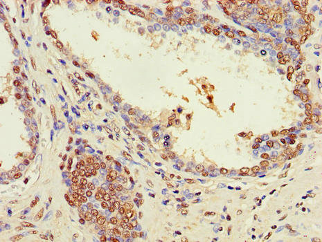 Immunohistochemistry of paraffin-embedded human prostate cancer at dilution of 1:100