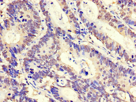 Immunohistochemistry of paraffin-embedded human colon cancer at dilution of 1:100