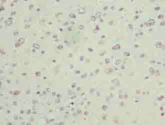 Immunohistochemistry of paraffin-embedded human glioma cancer using PARK7 Polyclonal Antibody at dilution of 1:100.