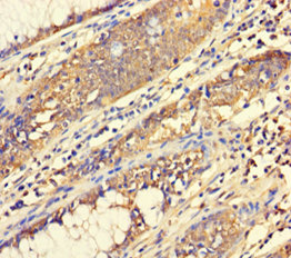 Immunohistochemistry of paraffin-embedded human colon cancer using ABHD18 Polyclonal Antibody at dilution 1:100