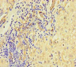 Immunohistochemistry of paraffin-embedded human liver cancer using L1TD1 Polyclonal Antibody at dilution of 1:100