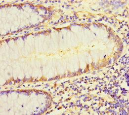 Immunohistochemistry of paraffin-embedded human colon cancer using L1TD1 Polyclonal Antibody at dilution of 1:100