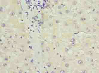 Immunohistochemistry of paraffin-embedded human liver cancer using PPP1R3B Polyclonal Antibody at dilution of 1:100.