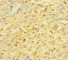 Immunohistochemistry of paraffin-embedded human melanoma cancer using ZSCAN29 Polyclonal Antibody at dilution of 1:100