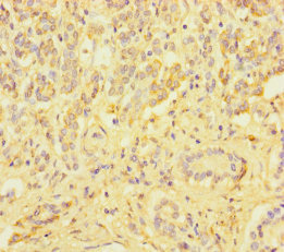 Immunohistochemistry of paraffin-embedded human pancreatic cancer using ZSCAN29 Polyclonal Antibody at dilution of 1:100