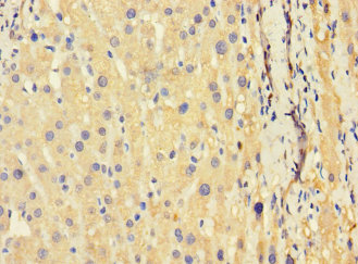Immunohistochemistry of paraffin-embedded human liver cancer using TSC22D3 Polyclonal Antibody at dilution 1:100
