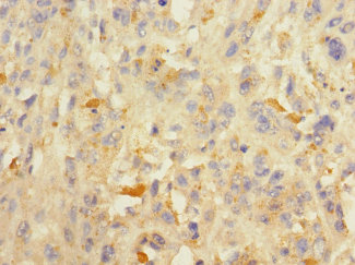 Immunohistochemistry of paraffin-embedded human melanoma ADAM7 Polyclonal Antibody at dilution 1:100