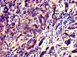 Immunohistochemistry of paraffin-embedded human pancreatic cancer using SPATC1L Polyclonal Antibody at dilution of 1:100