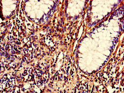 Immunohistochemistry of paraffin-embedded human colon cancer using NRIP2 Polyclonal Antibody at dilution of 1:100