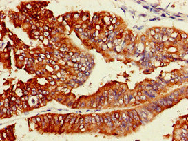 Immunohistochemistry of paraffin-embedded human endometrial cancer using ACSL5 Polyclonal Antibody at dilution of 1:100