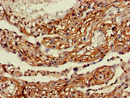 Immunohistochemistry of paraffin-embedded human lung cancer using ACSL5 Polyclonal Antibody at dilution of 1:100