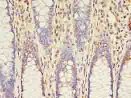 Immunohistochemistry of paraffin-embedded human colon cancer using ACSL5 Polyclonal Antibody at dilution of 1:100