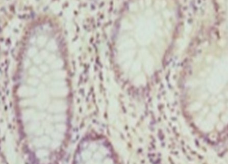 Immunohistochemistry of paraffin-embedded human colon cancer at dilution 1:100