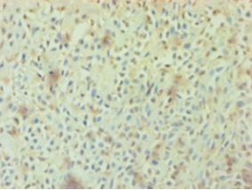 Immunohistochemistry of paraffin-embedded human breast cancer using AGO2 Polyclonal Antibody at dilution 1:100