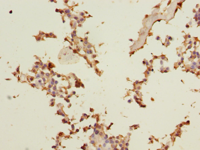 Immunohistochemistry of paraffin-embedded human breast cancer using AGO2 Polyclonal Antibody at dilution 1:100