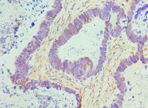 Immunohistochemistry of paraffin-embedded human ovarian cancer at dilution 1:100