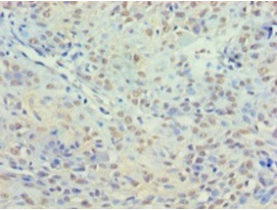 Immunohistochemistry of paraffin-embedded human breast cancer using HDAC3 Polyclonal Antibody at dilution 1:100