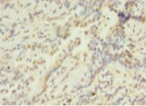 Immunohistochemistry of paraffin-embedded human lung cancer using HIST1H2AG Polyclonal Antibody at dilution 1:100