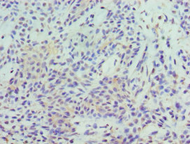 Immunohistochemistry of paraffin-embedded human breast cancer at dilution 1:100