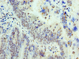 Immunohistochemistry of paraffin-embedded human colon cancer using THOC1 Polyclonal Antibody at dilution 1:100